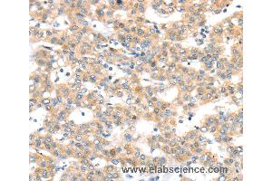 Immunohistochemistry of Human thyroid cancer using RAB24 Polyclonal Antibody at dilution of 1:45 (RAB24 抗体)