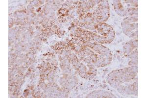 IHC-P Image Immunohistochemical analysis of paraffin-embedded human colon carcinoma, using GYG2, antibody at 1:500 dilution. (Glycogenin 2 抗体  (N-Term))
