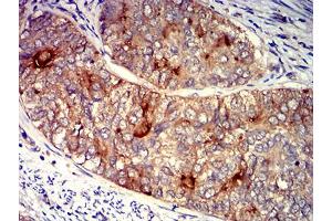 Immunohistochemical analysis of paraffin-embedded cervical cancer tissues using FOLR1 mouse mAb with DAB staining. (FOLR1 抗体  (AA 41-227))