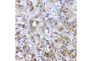 Immunohistochemistry of paraffin-embedded human liver cancer using IMPA1 antibody (ABIN2563424) at dilution of 1:100 (40x lens). (IMPA1 抗体)