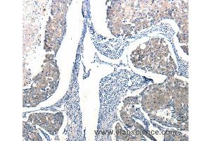 Immunohistochemistry of Human breast cancer using Ccl6 Polyclonal Antibody at dilution of 1:50 (CCL6 抗体)