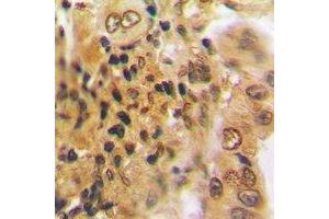 Immunohistochemical analysis of PSMD7 staining in human lung cancer formalin fixed paraffin embedded tissue section. (PSMD7 抗体)