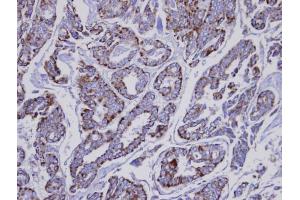 IHC-P Image Immunohistochemical analysis of paraffin-embedded human Thyroid gland tumor, using INPP1 , antibody at 1:100 dilution. (INPP1 抗体)