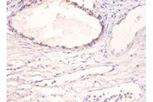 Immunohistochemistry of paraffin-embedded human prostate using BMP2 antibody at dilution of 1:100. (BMP2 抗体)