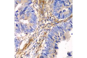 Immunohistochemistry of paraffin-embedded human colon carcinoma using HIP1 antibody at dilution of 1:100 (x40 lens). (HIP1 抗体)