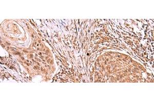 Immunohistochemistry of paraffin-embedded Human esophagus cancer tissue using IRX4 Polyclonal Antibody at dilution of 1:40(x200) (IRX4 抗体)