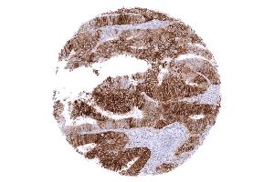 Colon Colorectal adenocarcinoma with moderate to strong membranous PD L1 staining in the vast majority of its tumor cells (Recombinant PD-L1 抗体)