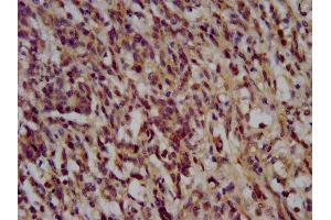 IHC image of ABIN7169549 diluted at 1:200 and staining in paraffin-embedded human gastric cancer performed on a Leica BondTM system. (NANS 抗体  (AA 132-259))