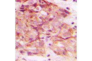 Immunohistochemical analysis of ERGIC3 staining in human breast cancer formalin fixed paraffin embedded tissue section. (ERGIC3 抗体  (C-Term))