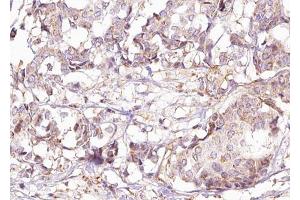 ABIN6267457 at 1/100 staining human Breast carcinoma tissue sections by IHC-P.