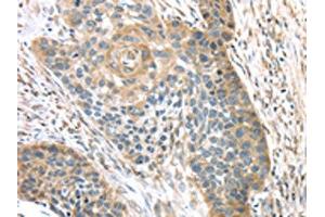 The image on the left is immunohistochemistry of paraffin-embedded Human esophagus cancer tissue using ABIN7131395(TMPRSS11A Antibody) at dilution 1/30, on the right is treated with fusion protein.