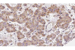 ABIN6272490 at 1/100 staining Human liver cancer tissue by IHC-P. (CACNA1G 抗体  (N-Term))