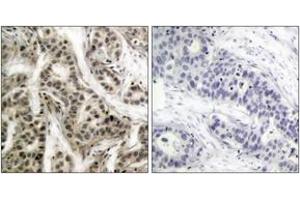 Immunohistochemistry analysis of paraffin-embedded human breast carcinoma, using NF-kappaB p105/p50 (Phospho-Ser337) Antibody. (NFKB1 抗体  (pSer337))