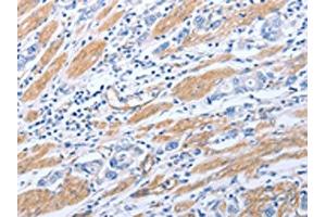 The image on the left is immunohistochemistry of paraffin-embedded Human gastric cancer tissue using ABIN7190790(GFRA4 Antibody) at dilution 1/40, on the right is treated with synthetic peptide. (GFRA4 抗体)