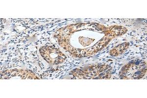 Immunohistochemistry of paraffin-embedded Human cervical cancer tissue using ZPBP Polyclonal Antibody at dilution of 1:30(x200) (ZPBP 抗体)