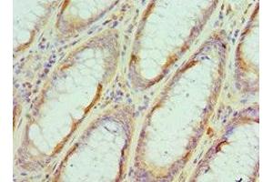 Immunohistochemistry of paraffin-embedded human colon cancer using ABIN7152105 at dilution of 1:100 (EIF4A1 抗体  (AA 167-406))