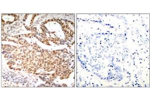 Immunohistochemical analysis of paraffin-embedded human breast carcinoma tissue using MEF2A (Phospho-Ser408) antibody (E011309). (MEF2A 抗体  (pSer408))
