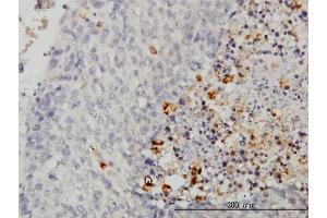 Immunoperoxidase of monoclonal antibody to CASP1 on formalin-fixed paraffin-embedded human hepatocellular carcinoma. (Caspase 1 抗体  (AA 1-100))