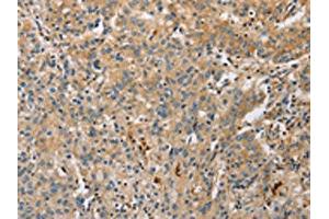 The image on the left is immunohistochemistry of paraffin-embedded Human gastric cancer tissue using ABIN7128517(ARL8A Antibody) at dilution 1/20, on the right is treated with fusion protein. (ARL8A 抗体)