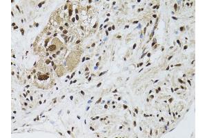 Immunohistochemistry of paraffin-embedded human colon carcinoma using STK11 antibody (ABIN5971149) at dilution of 1/100 (40x lens). (LKB1 抗体)