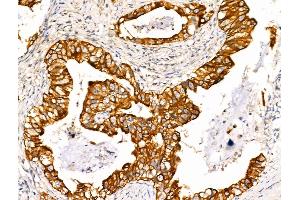 ABIN6265728 and ABIN6266730 at 1/100 staining Human lung cancer by IHC-P.