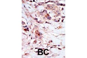 Formalin-fixed and paraffin-embedded human cancer tissue reacted with NPR1 polyclonal antibody  , which was peroxidase-conjugated to the secondary antibody, followed by AEC staining. (NPR1 抗体  (N-Term))