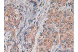 Detection of TLR1 in Human Breast cancer Tissue using Monoclonal Antibody to Toll Like Receptor 1 (TLR1) (TLR1 抗体  (AA 114-339))