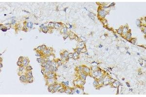 Immunohistochemistry of paraffin-embedded Human lung cancer using ART1 Polyclonal Antibody at dilution of 1:100 (40x lens). (ART1 抗体)