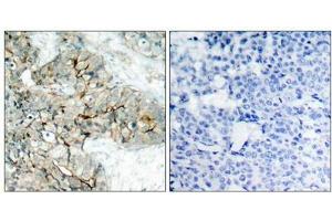 Immunohistochemical analysis of paraffin-embedded human breast carcinoma tissue using Integrin b3(Phospho-Tyr773) Antibody(left) or the same antibody preincubated with blocking peptide(right). (Integrin beta 3 抗体  (pTyr773))