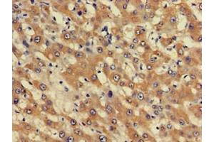 Immunohistochemistry of paraffin-embedded human liver cancer using ABIN7163052 at dilution of 1:100 (PHF21A 抗体  (AA 312-487))