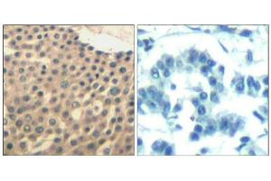 Immunohistochemical analysis of paraffin-embedded human lung carcinoma tissue using HDAC4/HDAC5/HDAC9(Ab-246/259/220) Antibody(left) or the same antibody preincubated with blocking peptide(right). (HDAC4/HDAC5/HDAC9 抗体)
