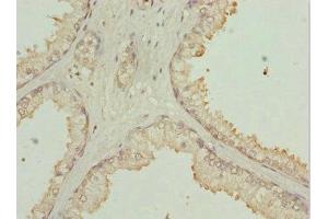 Immunohistochemistry of paraffin-embedded human prostate cancer using ABIN7169213 at dilution of 1:100 (ULK3 抗体  (AA 44-240))