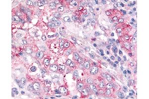Anti-USP4 / UNP antibody IHC of human Lung, Non-Small Cell Carcinoma. (USP4 抗体  (N-Term))