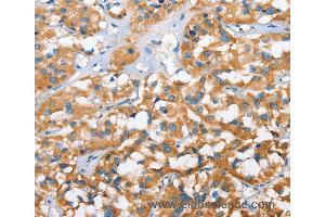 Immunohistochemistry of Human thyroid cancer using CXCL14 Polyclonal Antibody at dilution of 1:40 (CXCL14 抗体)