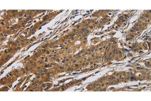 Immunohistochemistry of paraffin-embedded Human gastric cancer tissue using Claudin 2 Polyclonal Antibody at dilution 1:50 (Claudin 2 抗体)