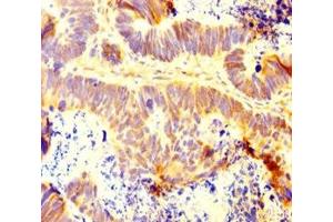 Immunohistochemistry of paraffin-embedded human ovarian cancer using ABIN7156421 at dilution of 1:100