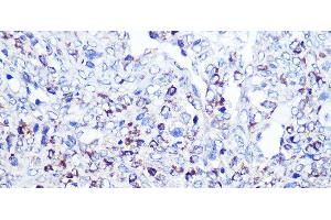 Immunohistochemistry of paraffin-embedded Human oophoroma using CD68 Polyclonal Antibody at dilution of 1:100 (40x lens). (CD68 抗体)