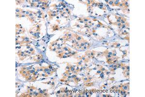 Immunohistochemistry of Human thyroid cancer using AHR Polyclonal Antibody at dilution of 1:50 (Aryl Hydrocarbon Receptor 抗体)