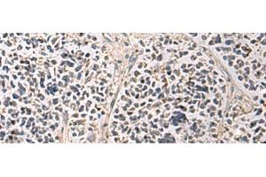 Immunohistochemistry of paraffin-embedded Human breast cancer tissue using PAIP1 Polyclonal Antibody at dilution of 1:80(x200) (PAIP1 抗体)