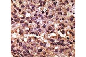 IHC analysis of FFPE human breast carcinoma tissue stained with the BNIP3 antibody (BNIP3 抗体  (AA 152-187))