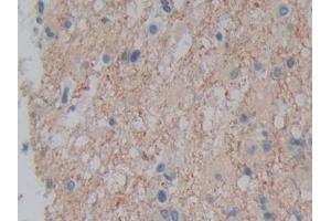 IHC-P analysis of Human Glioma Tissue, with DAB staining. (Plexin A1 抗体  (AA 43-300))