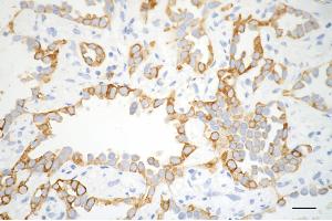 Immunohistochemistry was performed on paraffin-embedded human lung adenocarcinoma using CD8 alpha antibody (ABIN7797987), 1:200). (Recombinant CD8 alpha 抗体)