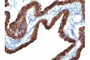 Formalin-fixed, paraffin-embedded human Ovarian Carcinoma stained with Cytokeratin 7 Monoclonal Antibody (KRT7/760 + OV-TL12/30) (Cytokeratin 7 抗体)