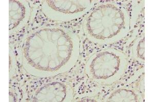 Immunohistochemistry of paraffin-embedded human colon cancer using ABIN7142353 at dilution of 1:100 (MRPL14 抗体  (AA 1-145))