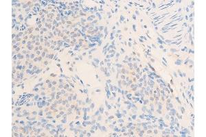 Immunohistochemistry (IHC) image for anti-Receptor tyrosine-protein kinase erbB-2 (ErbB2/Her2) (pTyr877) antibody (ABIN6256054)