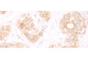 Immunohistochemistry of paraffin-embedded Human liver cancer tissue using TRMT1 Polyclonal Antibody at dilution of 1:25(x200)