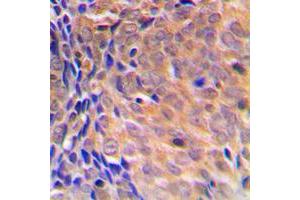 Immunohistochemical analysis of COPS3 staining in human breast cancer formalin fixed paraffin embedded tissue section. (COPS3 抗体  (Center))