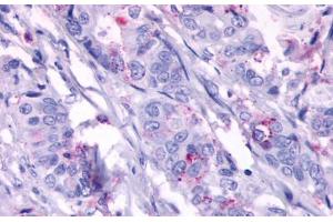 Anti-GPR124 antibody  ABIN1048704 IHC staining of human colon carcinoma, neoplastic cells. (GPR124 抗体  (N-Term))