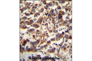 TFAM antibody immunohistochemistry analysis in formalin fixed and paraffin embedded human testis carcinoma followed by peroxidase conjugation of the secondary antibody and DAB staining. (TFAM 抗体  (C-Term))