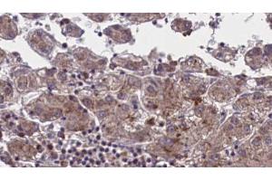 ABIN6273959 at 1/100 staining Human liver cancer tissue by IHC-P. (OR51M1 抗体  (C-Term))